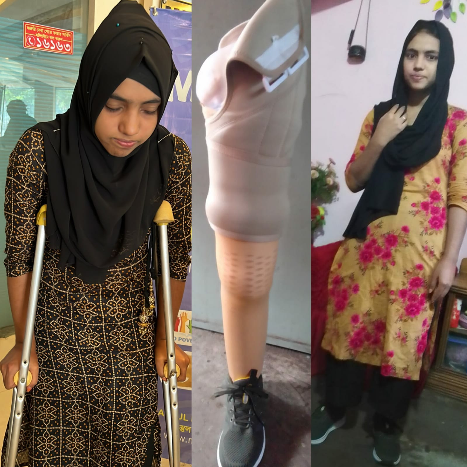 Shima's Journey to Recovery with Mastulaid’s Lifesaving Artificial Leg Support